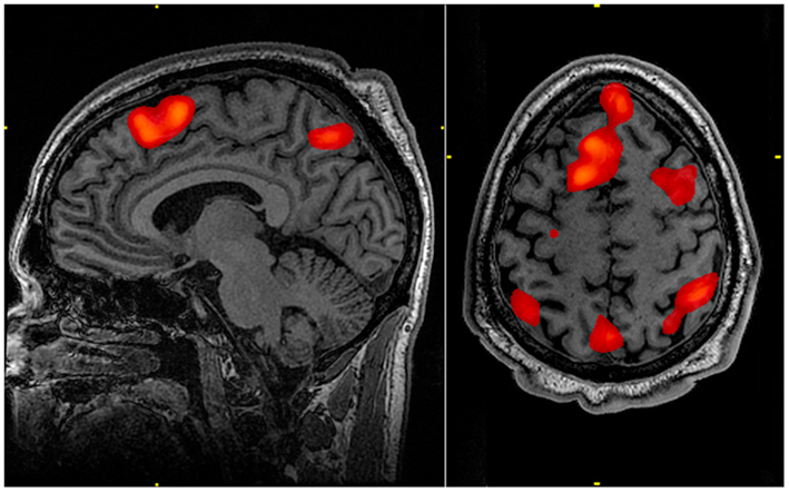 FMRI scans show “hot spots” of human brain activity as subjects perform memory tasks. The brain contains 100 billion nerve cells, or neurons, with 100 trillion connections, or synapses. FMRI scans show “hot spots” of human brain activity as subjects perform memory tasks. The brain contains 100 billion nerve cells, or neurons, with 100 trillion connections, or synapses.