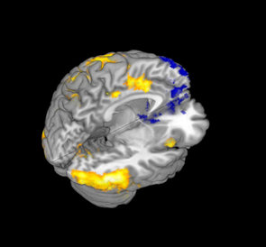 The fMRI image above depicts areas of the brain associated with the competing motivations of minimizing guilt (yellow) and maximizing financial reward (blue) when participants decide whether or not they want to honor an investment partner's trust. The motivation to minimize guilt is associated with the insula, anterior cingulate cortex and supplementary motor area (yellow). The motivation to maximize financial reward is associated with the ventral striatum, ventromedial prefrontal cortex and dorsomedial prefrontal cortex. (Image courtesy Luke Chang/UA psychology department) The fMRI image above depicts areas of the brain associated with the competing motivations of minimizing guilt (yellow) and maximizing financial reward (blue) when participants decide whether or not they want to honor an investment partner's trust. The motivation to minimize guilt is associated with the insula, anterior cingulate cortex and supplementary motor area (yellow). The motivation to maximize financial reward is associated with the ventral striatum, ventromedial prefrontal cortex and dorsomedial prefrontal cortex. (Image courtesy Luke Chang/UA psychology department)