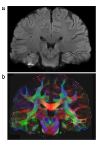 These high-resolution diffusion-weighted magnetic resonance images show the structural connection to the hippocampus, which is the most important brain region involved in memory. The lower image (b) is color-coded, with red indicating left-right structural connectivity, green indicating anterior-posterior connectivity and blue indicating superior-inferior connectivity. (Image: Nan-kuei Chen) These high-resolution diffusion-weighted magnetic resonance images show the structural connection to the hippocampus, which is the most important brain region involved in memory. The lower image (b) is color-coded, with red indicating left-right structural connectivity, green indicating anterior-posterior connectivity and blue indicating superior-inferior connectivity. (Image: Nan-kuei Chen)
