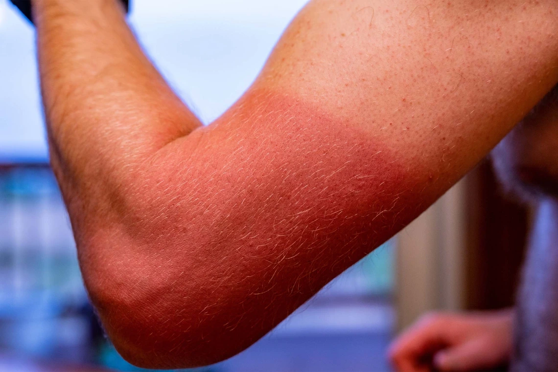 a person's subburned arm
