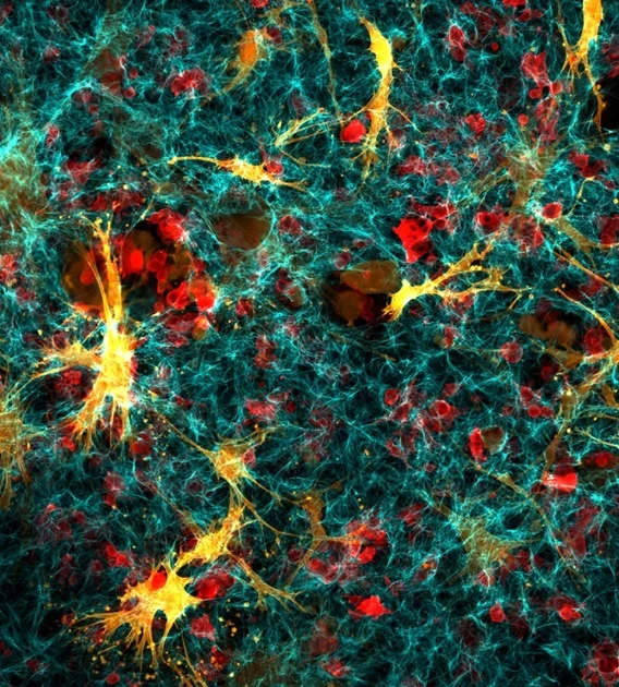 An illustration of confocal cancer cells and fibroblasts in collagen