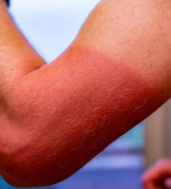 a person's subburned arm