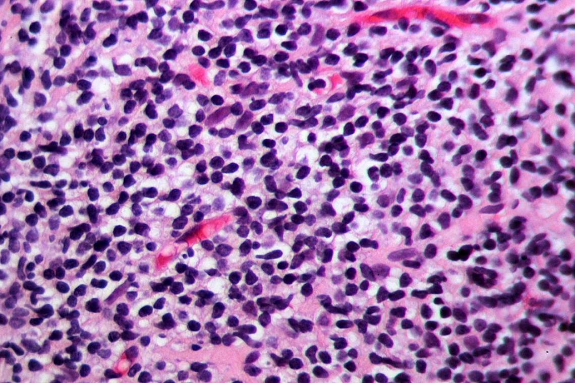 Gastritis resulting from infection by the H. pylori bacterium Gastritis resulting from infection by the H. pylori bacterium
