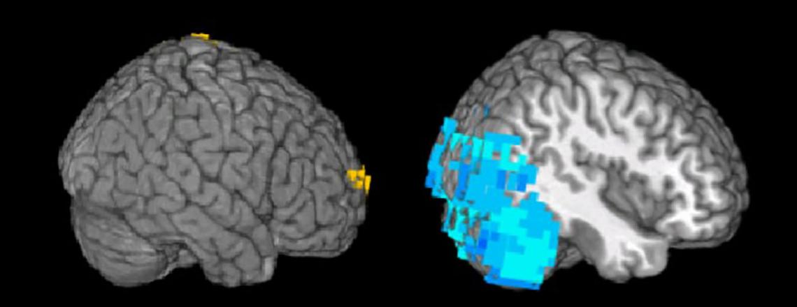 A person with primary progressive aphasia activates part of the right-hand side of their brain to decipher a sentence, whereas the normal person does not. A person with primary progressive aphasia activates part of the right-hand side of their brain to decipher a sentence, whereas the normal person does not.