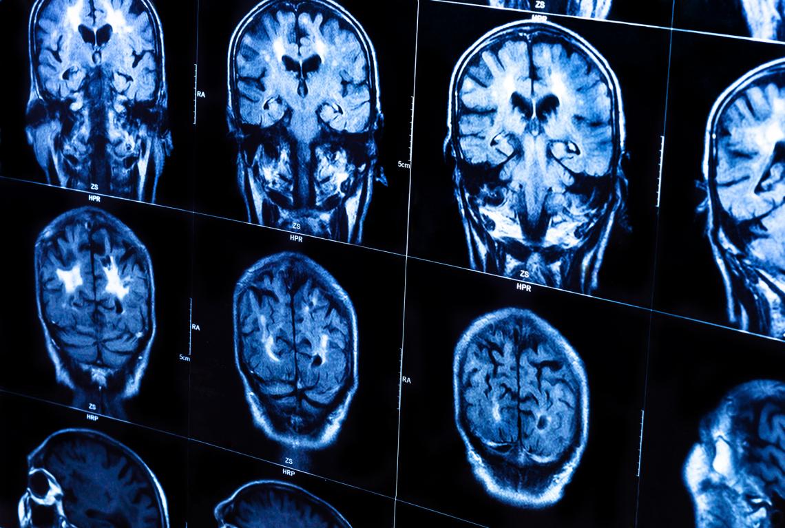 Ying-hui Chou will couple the power of MRI technology with transcranial magnetic stimulation to improve memory function in patients with mild cognitive impairment. Ying-hui Chou will couple the power of MRI technology with transcranial magnetic stimulation to improve memory function in patients with mild cognitive impairment.