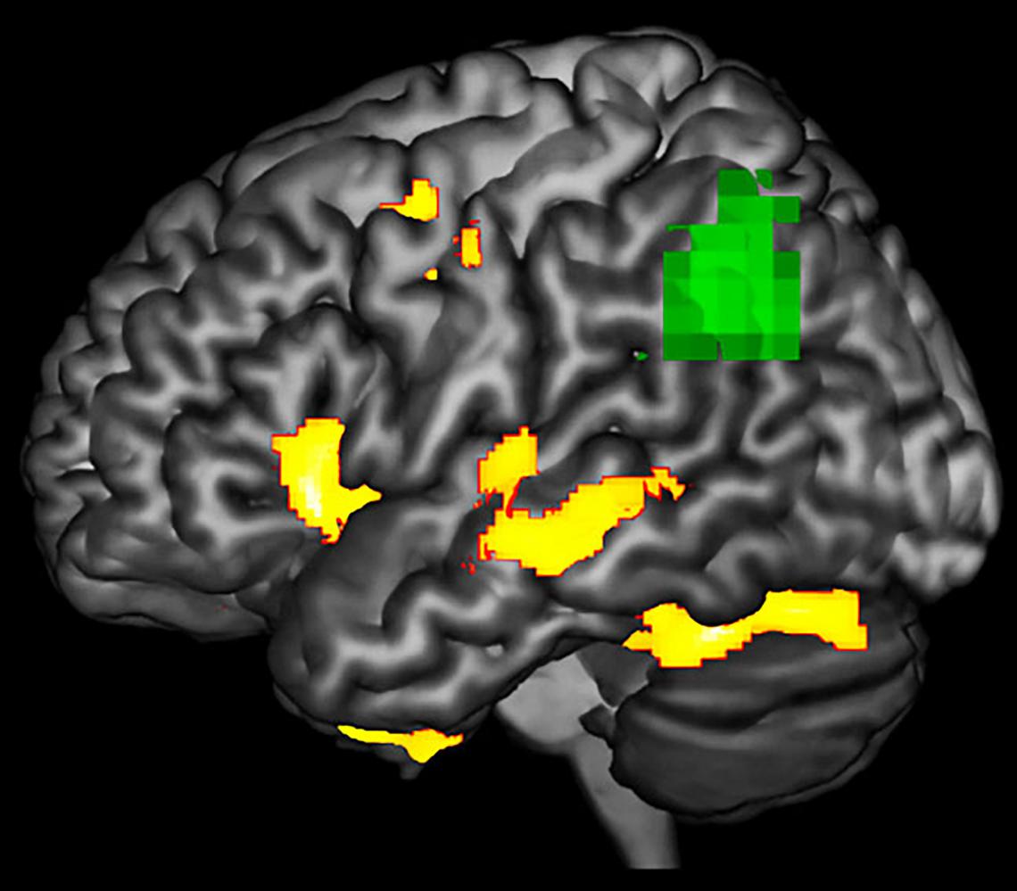 This image highlights areas in a brain with PPA during a language task where researchers observed functional abnormality and structural degenerating . The green areas may be at-risk or dysfunctional, even if the neurons are not yet dead. This image highlights areas in a brain with PPA during a language task where researchers observed functional abnormality and structural degenerating . The green areas may be at-risk or dysfunctional, even if the neurons are not yet dead.